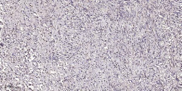 Immunohistochemical analysis of paraffin-embedded human small intestinal carcinoma tissue
