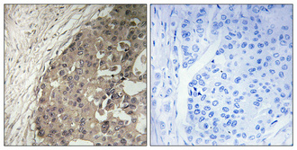 Immunohistochemistry analysis of paraffin-embedded human breast carcinoma tissue, using CSGALNACT1 Antibody