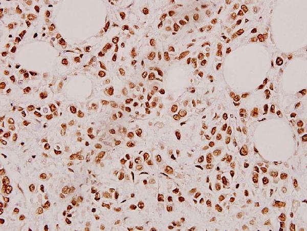 Immunohistochemistry (IHC) analyzes of Cardiotrophin-1 (H31) pAb in paraffin-embedded human breast carcinoma tissue at 1:100