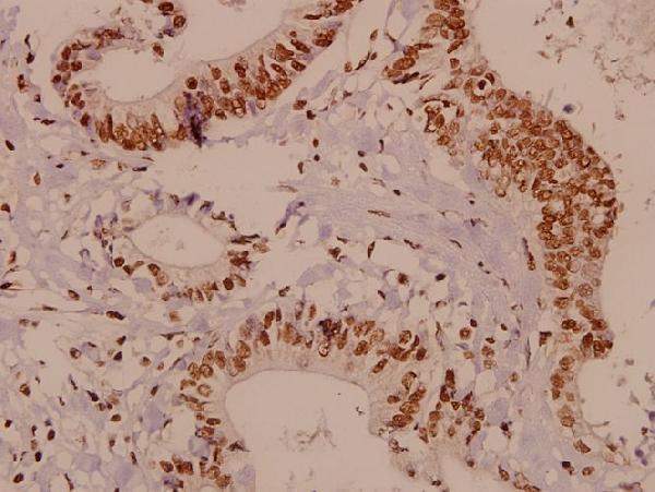Immunohistochemistry (IHC) analyzes of HES-6 (A6) pAb in paraffin-embedded human colorectal carcinoma tissue at 1:50