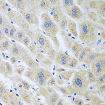 Immunohistochemistry of paraffin-embedded human liver cancer using BLVRB antibody  at dilution of 1:100 