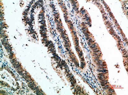 Immunohistochemical analysis of paraffin-embedded human-colon-cancer, antibody was diluted at 1:200