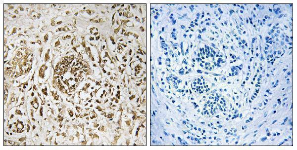 Immunohistochemistry analysis of paraffin-embedded human breast carcinoma tissue, using CIB2 Antibody