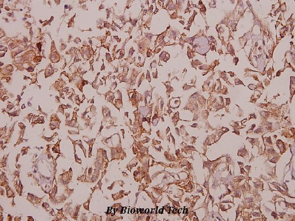 Immunohistochemistry (IHC) analyzes of MaxiKβ2 (I186) pAb in paraffin-embedded human breast carcinoma tissue at 1:50