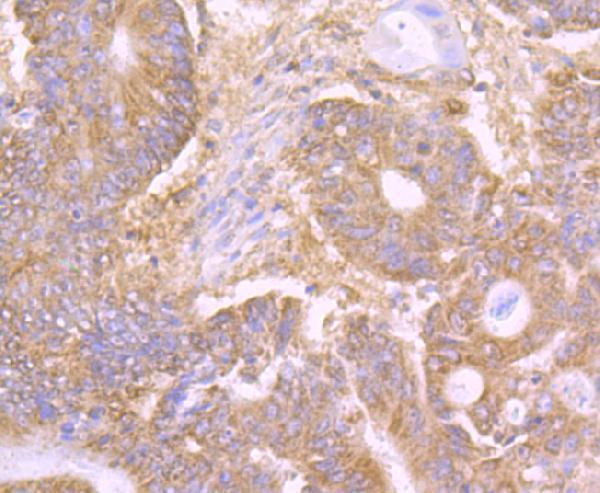 Immunohistochemical analysis of paraffin-embedded human colon cancer tissue using anti-LY75 antibody