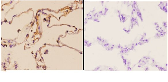 Immunohistochemistry (IHC) analyzes of FGF 22 (A96) pAb in paraffin-embedded human lung carcinoma tissue at 1:50,showing secreted staining
