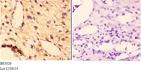 Immunohistochemistry (IHC) analyzes of FGF 22 (A96) pAb in paraffin-embedded human kidney carcinoma tissue at 1:50,showing secreted staining
