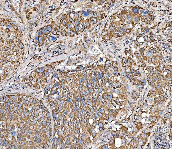  IHC analysis of SUCLG2 using anti-SUCLG2 antibody (A08268-1)