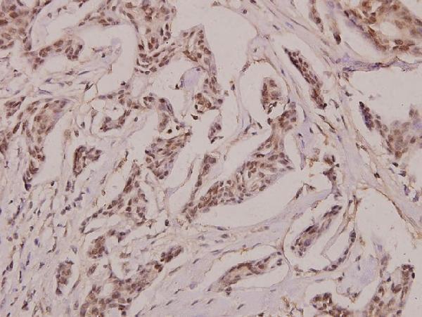 Immunohistochemistry (IHC) analyzes of Laminin β-2 (C91) pAb in paraffin-embedded human breast carcinoma tissue at 1:100