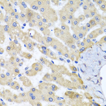 Immunohistochemistry of paraffin-embedded human liver damage using ABCB8 antibody  at dilution of 1:100 