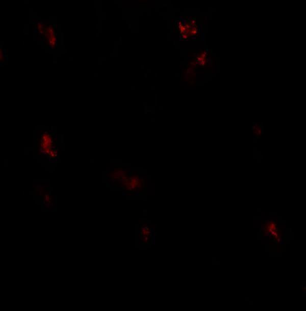 Immunofluorescence of GPRASP1 in human breast carcinoma tissue with GPRASP1 antibody at 20 μg/ml