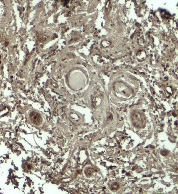 Immunohistochemistry of GPRASP1 in human breast carcinoma tissue with GPRASP12 antibody at 5 μg/ml