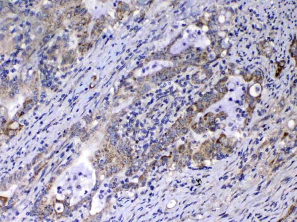 IHC analysis of Relaxin 1 using anti-Relaxin 1 antibody (A08367-1). Relaxin 1 was detected in paraffin-embedded section of human colon cancer tissue. Heat mediated antigen retrieval was performed in citrate buffer (pH6, epitope retrieval solution) for 20 mins. The tissue section was blocked with 10% goat serum. The tissue section was then incubated with 1ug/ml rabbit anti-Relaxin 1 Antibody (A08367-1) overnight at 4 Biotinylated goat anti-rabbit IgG was used as secondary antibody and incubated for 30 minutes at 37 The tissue section was developed using Strepavidin-Biotin-Complex (SABC)(Catalog # SA1022) with DAB as the chromogen.