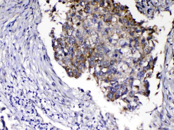 IHC analysis of Relaxin 1 using anti-Relaxin 1 antibody (A08367-1). Relaxin 1 was detected in paraffin-embedded section of human lung cancer tissue. Heat mediated antigen retrieval was performed in citrate buffer (pH6, epitope retrieval solution) for 20 mins. The tissue section was blocked with 10% goat serum. The tissue section was then incubated with 1ug/ml rabbit anti-Relaxin 1 Antibody (A08367-1) overnight at 4 Biotinylated goat anti-rabbit IgG was used as secondary antibody and incubated for 30 minutes at 37 The tissue section was developed using Strepavidin-Biotin-Complex (SABC)(Catalog # SA1022) with DAB as the chromogen.
