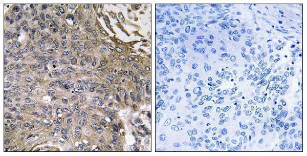 Immunohistochemistry analysis of paraffin-embedded human lung carcinoma, using SH2D1B Antibody