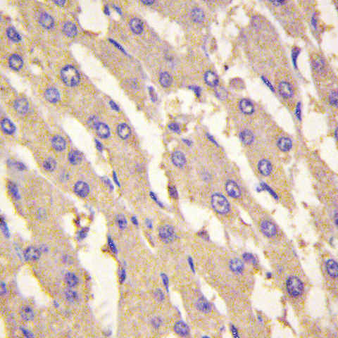 Immunohistochemistry (IHC) analyzes of PFKFB1 (E442) pAb in paraffin-embedded human liver carcinoma tissue at 1:100