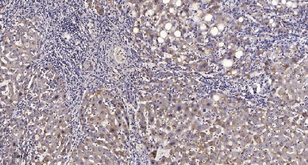 Immunohistochemical analysis of paraffin-embedded human liver cancer