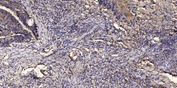 Immunohistochemical analysis of paraffin-embedded human Squamous cell carcinoma of lung