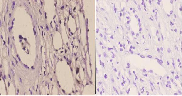 Immunohistochemistry (IHC) analyzes of TFIIH p44 (T18) pAb in paraffin-embedded human kidney carcinoma tissue at 1:50