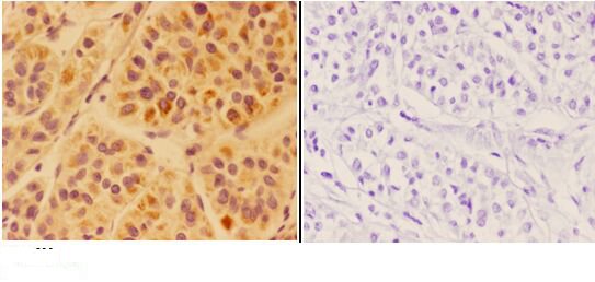 Immunohistochemistry (IHC) analyzes of APOC4 pAb in paraffin-embedded human liver carcinoma tissue at 1:50,showing secreted staining