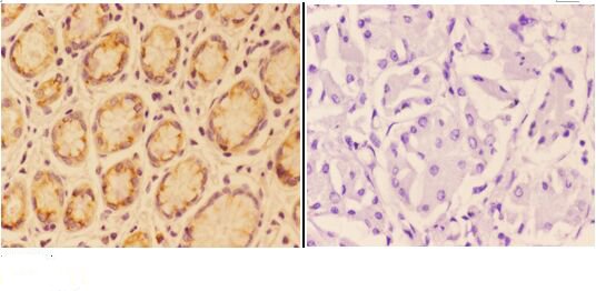 Immunohistochemistry (IHC) analyzes of ANGPT4 pAb in paraffin-embedded human stomach carcinoma tissue at 1:50,showing secreted staining