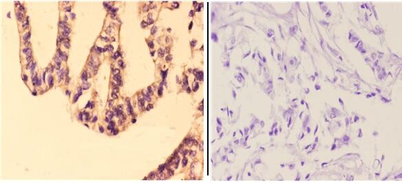 Immunohistochemistry (IHC) analyzes of Granzyme H (G75) pAb in paraffin-embedded human breast carcinoma tissue at 1:50