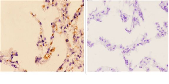 Immunohistochemistry (IHC) analyzes of Granzyme H (G75) pAb in paraffin-embedded human lung carcinoma tissue at 1:50