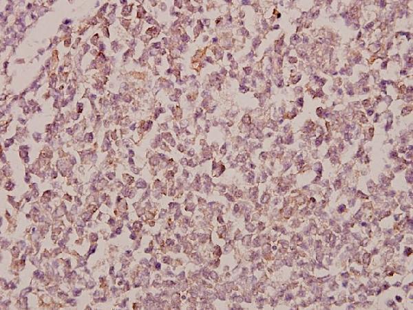Immunohistochemistry (IHC) analyzes of RhoBTB1/2 (T85) pAb in paraffin-embedded human tonsil carcinoma tissue at 1:50