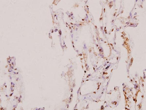 Immunohistochemistry (IHC) analyzes of SENP5 (L681) pAb in paraffin-embedded human lung carcinoma tissue at 1:100
