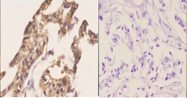 Immunohistochemistry (IHC) analyzes of Cables1 (K588) pAb in paraffin-embedded human breast carcinoma tissue at 1:50
