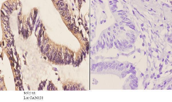 Immunohistochemistry (IHC) analyzes of Cables1 (K588) pAb in paraffin-embedded human colon carcinoma tissue at 1:50