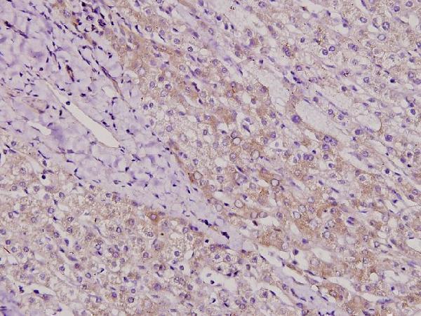 Immunohistochemistry (IHC) analyzes of TAF II p100 (G411) pAb in paraffin-embedded liver cancer tissue at 1:100