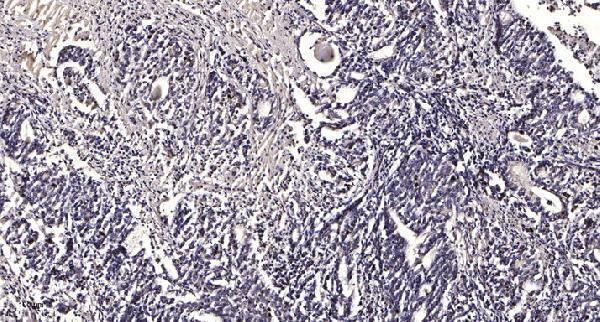 Immunohistochemical analysis of paraffin-embedded human Gastric adenocarcinoma