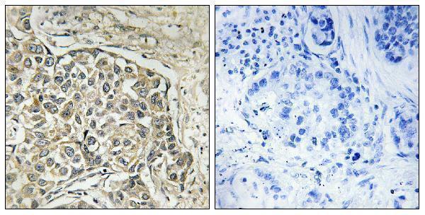 Immunohistochemistry analysis of paraffin-embedded human lung carcinoma tissue, using ARSD Antibody