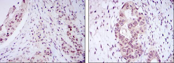 Immunohistochemistry analysis of paraffin-embedded mammary cancer tissues (left) and ovarian cancer tissues (right) with DAB staining using NAC-1 Monoclonal Antibody