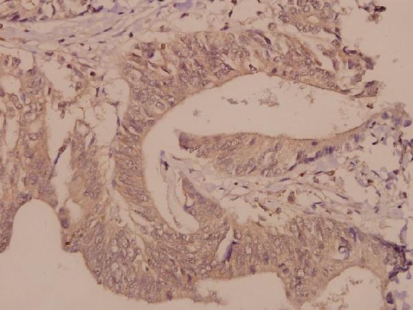 Immunohistochemistry (IHC) analyzes of DGK-θ (S725) pAb in paraffin-embedded human colorectal carcinoma tissue at 1:50