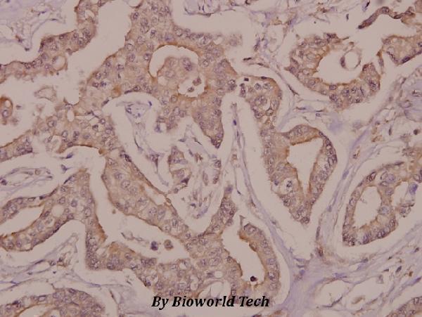 Immunohistochemistry (IHC) analyzes of DRAK2 (I286) pAb in paraffin-embedded human breast carcinoma tissue at 1:50