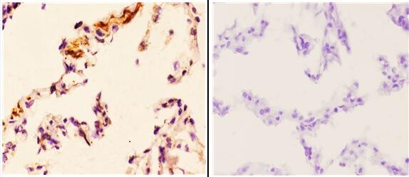 Immunohistochemistry (IHC) analyzes of FoxL1 (G150) pAb in paraffin-embedded human lung carcinoma tissue at 1:50