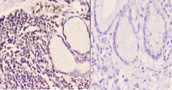 Immunohistochemistry (IHC) analyzes of IP6K2 (L188) pAb in paraffin-embedded human esophageal carcinoma tissue at 1:50