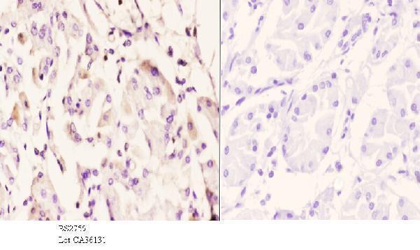 Immunohistochemistry (IHC) analyzes of IP6K2 (L188) pAb in paraffin-embedded human stomach carcinoma tissue at 1:50