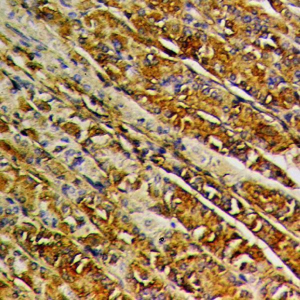 Immunohistochemistry (IHC) analyzes of EIF2S2 polyclonal antibody in paraffin-embedded human stomach cancer tissue at 1:50