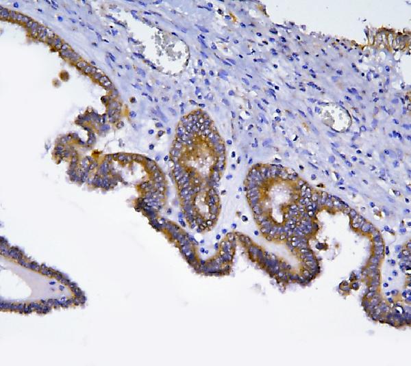 Figure 2. IHC analysis of HOOK2 using anti-HOOK2 antibody (A08854-1). HOOK2 was detected in a paraffin-embedded section of human ovarian cancer tissue. Heat mediated antigen retrieval was performed in EDTA buffer (pH 8.0, epitope retrieval solution). The tissue section was blocked with 10% goat serum. The tissue section was then incubated with 2 microg/ml rabbit anti-HOOK2 Antibody (A08854-1) overnight at 4°C. Peroxidase Conjugated Goat Anti-rabbit IgG was used as secondary antibody and incubated for 30 minutes at 37°C. The tissue section was developed using HRP Conjugated Rabbit IgG Super Vision Assay Kit (Catalog # SV0002) with DAB as the chromogen.