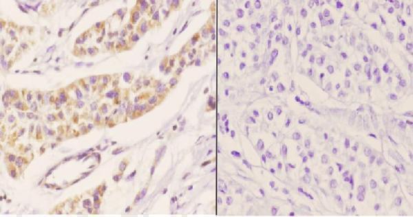 Immunohistochemistry (IHC) analyzes of Peroxin-11B pAb in paraffin-embedded human liver carcinoma tissue at 1:50