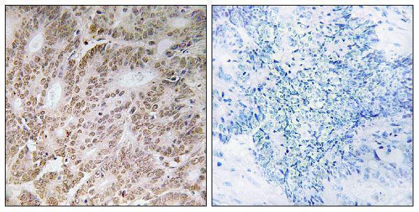Immunohistochemistry analysis of paraffin-embedded human colon carcinoma tissue, using UBQLN4 Antibody
