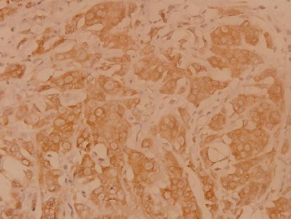 Immunohistochemistry (IHC) analyzes of DAPP1 (E135) pAb in paraffin-embedded human breast carcinoma tissue at 1:100