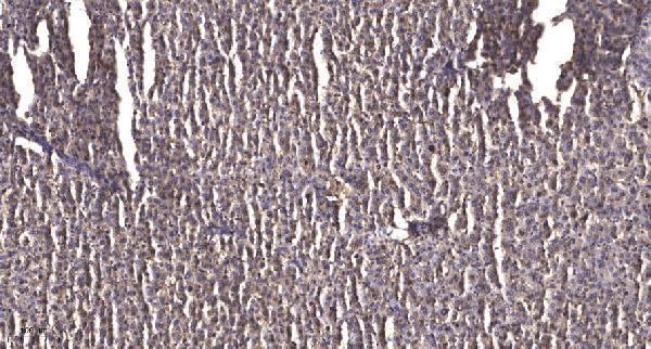 Immunohistochemical analysis of paraffin-embedded human liver cancer