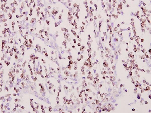 Immunohistochemistry (IHC) analyzes of Cox-11 (F80) pAb in paraffin-embedded human tonsil cancer tissue at 1:50