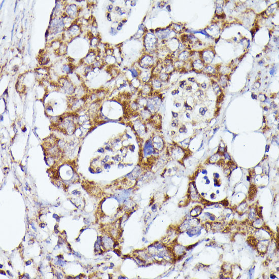 Immunohistochemistry of paraffin-embedded human colon carcinoma using CDK5RAP1 antibody  at dilution of 1:100 