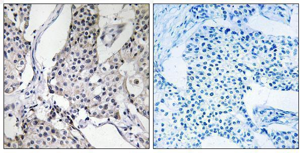 Immunohistochemistry analysis of paraffin-embedded human breast carcinoma tissue, using PHLDA3 Antibody