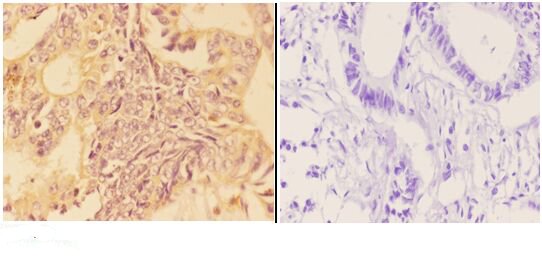 Immunohistochemistry (IHC) analyzes of APOBR pAb in paraffin-embedded human rectum carcinoma tissue at 1:50,showing cytoplasmic staining